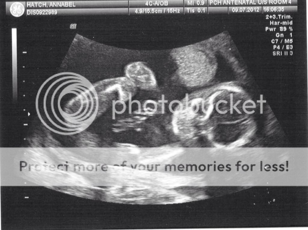 Do baby boys have balls at 20 weeks? Page 3 BabyCenter